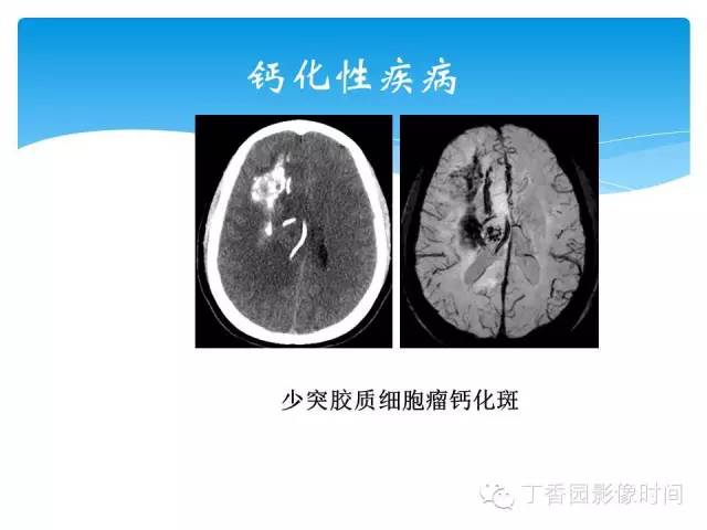 【PPT】SWI的临床应用