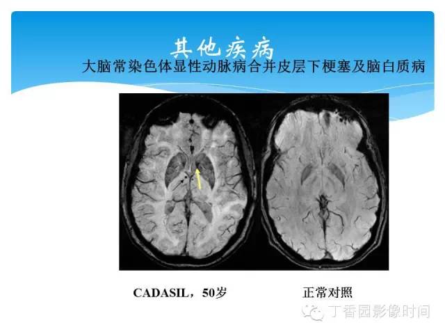 【PPT】SWI的临床应用