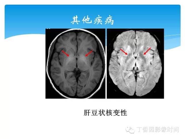 【PPT】SWI的临床应用