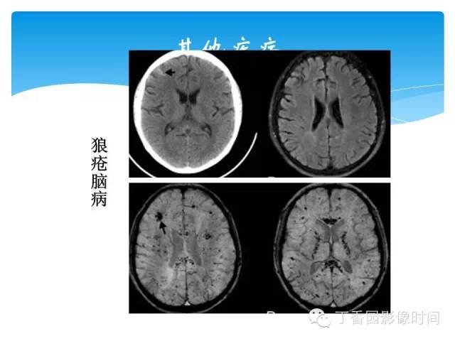 【PPT】SWI的临床应用