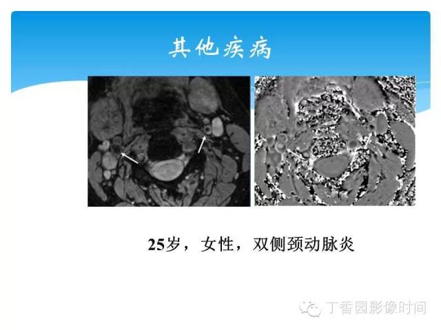 【PPT】SWI的临床应用