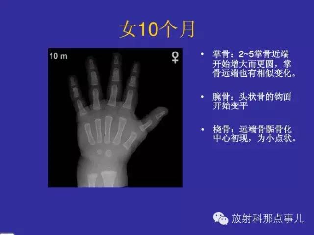 【PPT】正常女性骨龄图谱