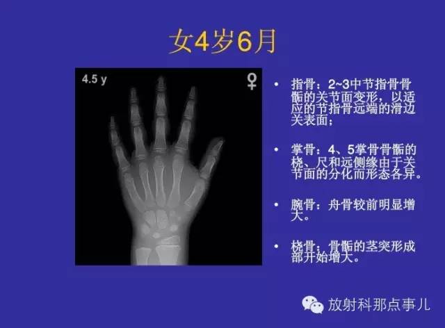 【PPT】正常女性骨龄图谱