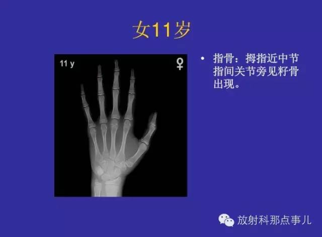 【PPT】正常女性骨龄图谱