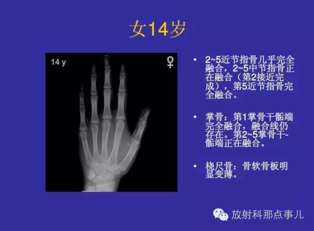 【PPT】正常女性骨龄图谱