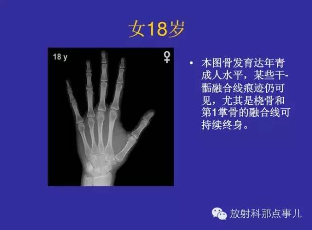 【PPT】正常女性骨龄图谱