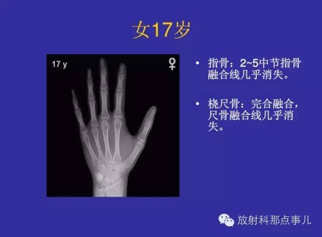 【PPT】正常女性骨龄图谱