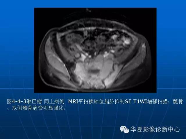 【PPT】盆壁病变影像诊断