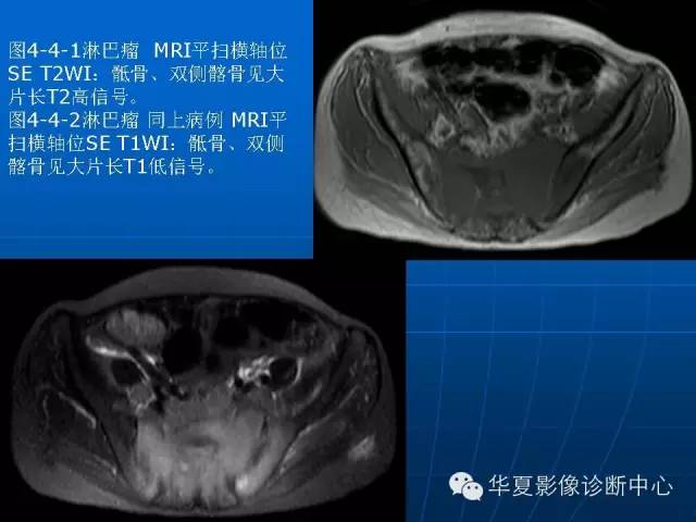 【PPT】盆壁病变影像诊断