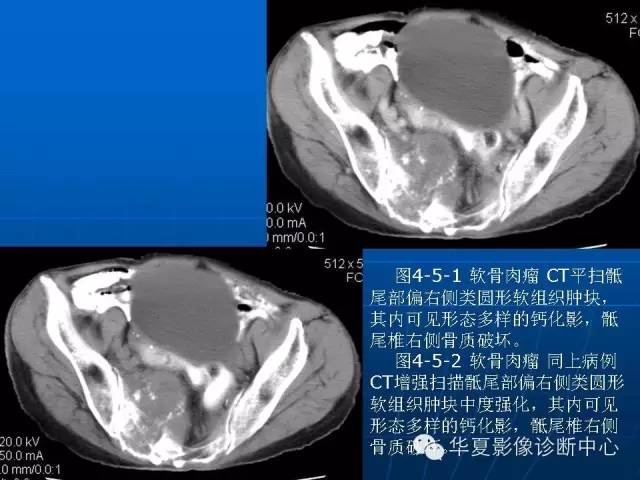 【PPT】盆壁病变影像诊断