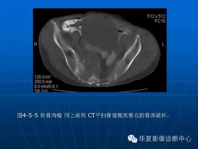 【PPT】盆壁病变影像诊断