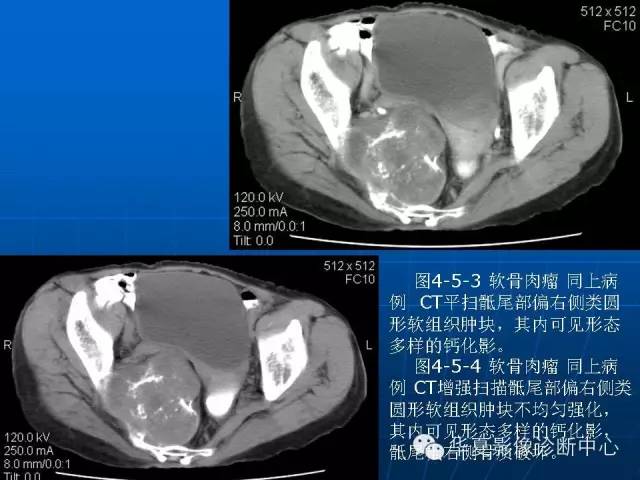【PPT】盆壁病变影像诊断