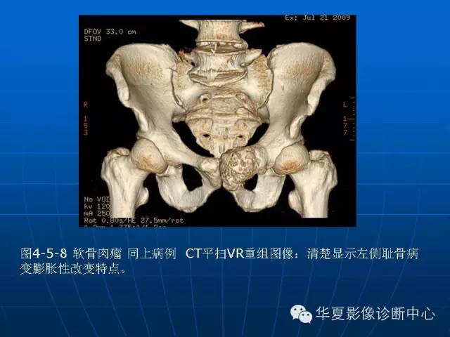 【PPT】盆壁病变影像诊断