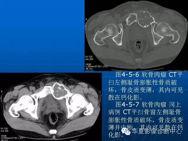 【PPT】盆壁病变影像诊断