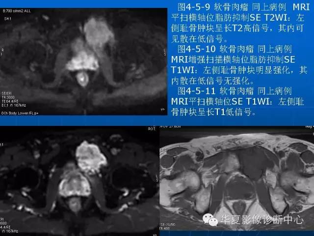 【PPT】盆壁病变影像诊断