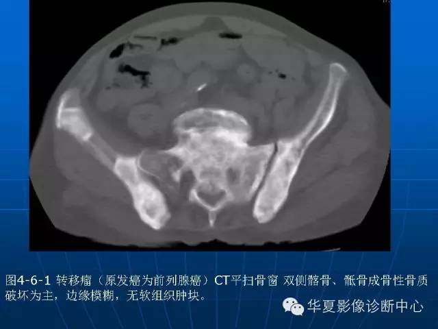 【PPT】盆壁病变影像诊断