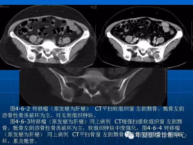 【PPT】盆壁病变影像诊断