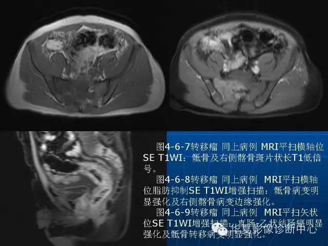 【PPT】盆壁病变影像诊断