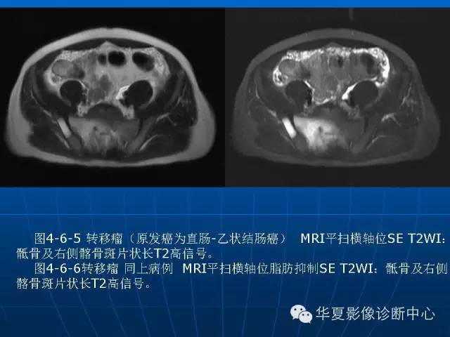 【PPT】盆壁病变影像诊断