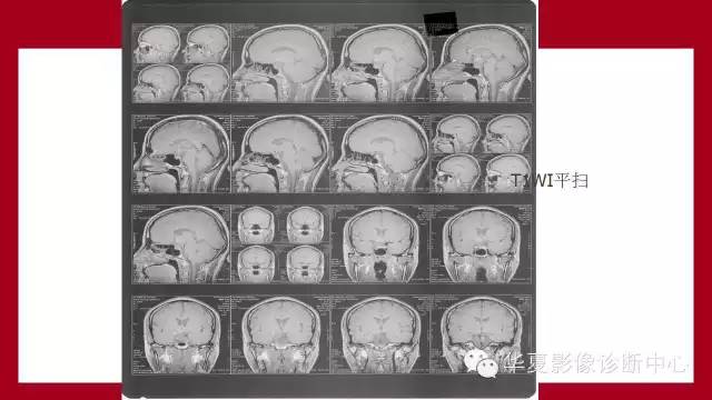 【病例】鞍区软骨粘液样纤维瘤1例CT及MR影像表现