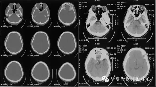 【病例】鞍区软骨粘液样纤维瘤1例CT及MR影像表现