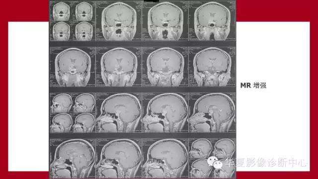 【病例】鞍区软骨粘液样纤维瘤1例CT及MR影像表现