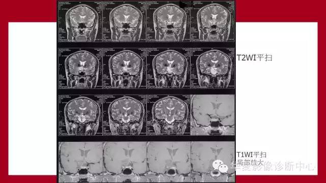 【病例】鞍区软骨粘液样纤维瘤1例CT及MR影像表现