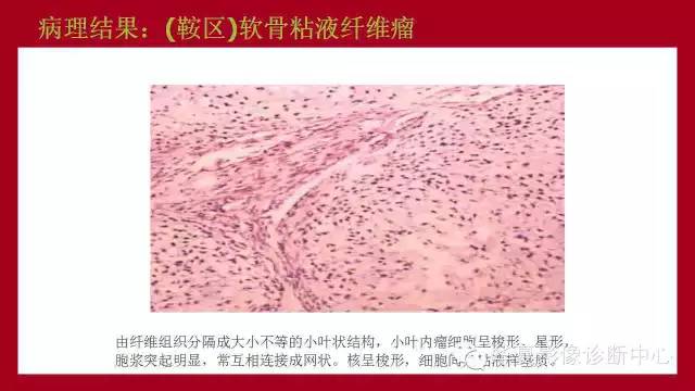 【病例】鞍区软骨粘液样纤维瘤1例CT及MR影像表现