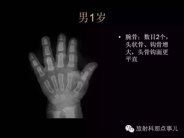 【PPT】正常男性骨龄图谱