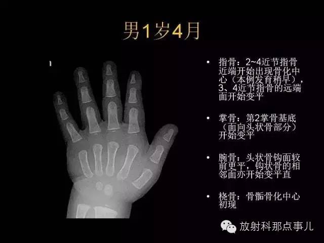 【PPT】正常男性骨龄图谱