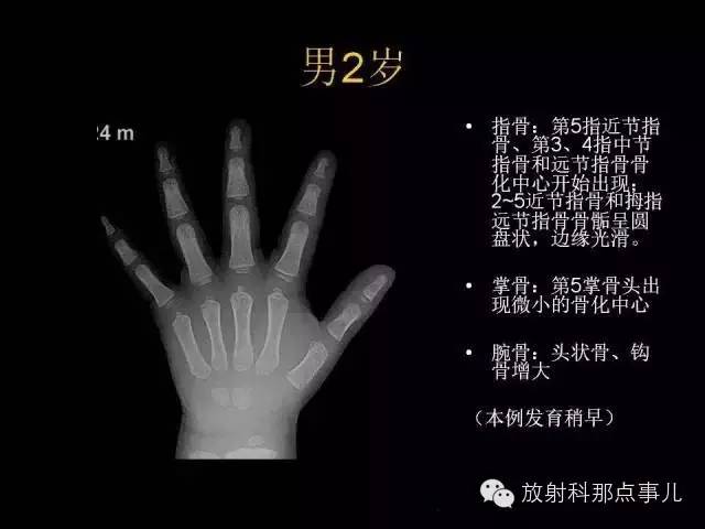 【PPT】正常男性骨龄图谱