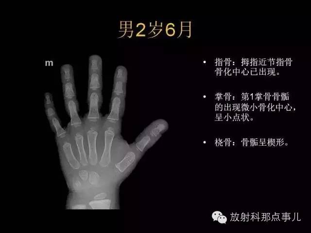 【PPT】正常男性骨龄图谱