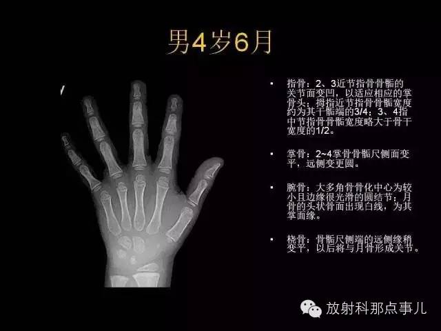 【PPT】正常男性骨龄图谱
