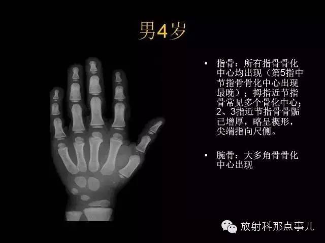 【PPT】正常男性骨龄图谱