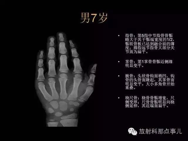 【PPT】正常男性骨龄图谱