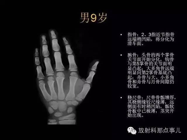 【PPT】正常男性骨龄图谱