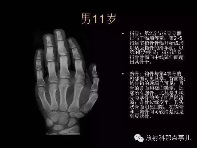 【PPT】正常男性骨龄图谱