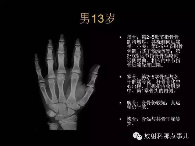 【PPT】正常男性骨龄图谱