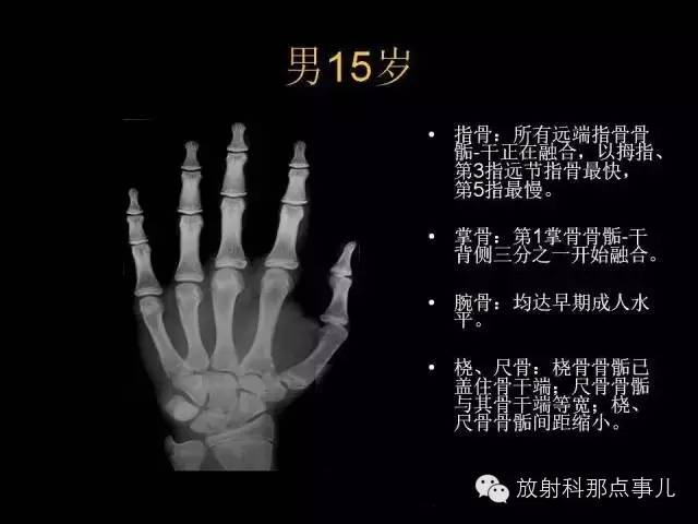 【PPT】正常男性骨龄图谱