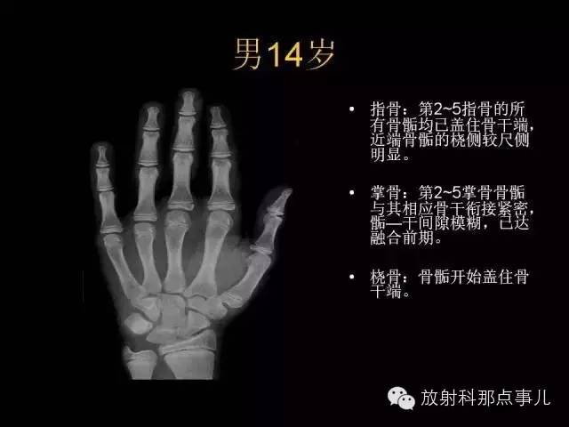 【PPT】正常男性骨龄图谱