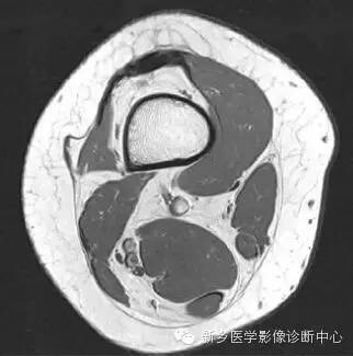 膝关节断层解剖+详细标注