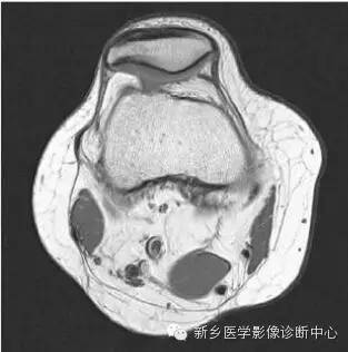 膝关节断层解剖+详细标注