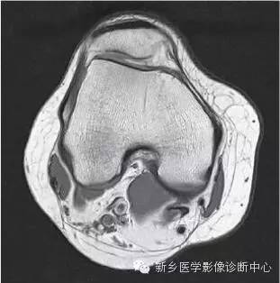 膝关节断层解剖+详细标注