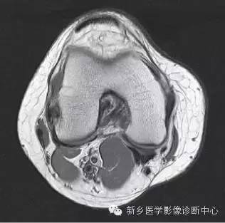 膝关节断层解剖+详细标注