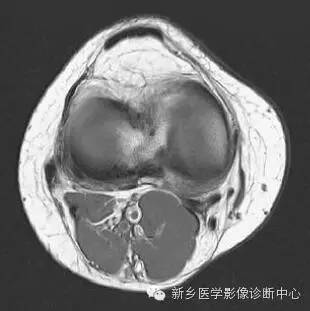 膝关节断层解剖+详细标注
