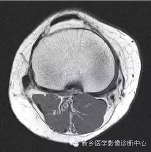 膝关节断层解剖+详细标注