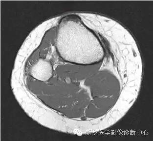 膝关节断层解剖+详细标注