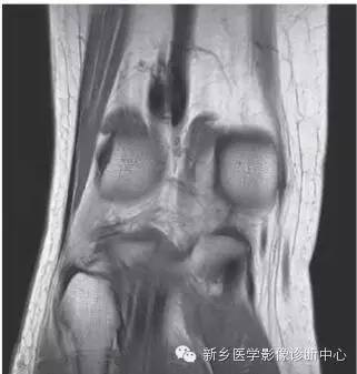 膝关节断层解剖+详细标注