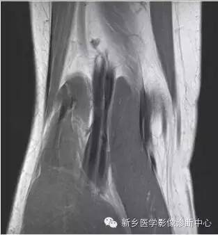 膝关节断层解剖+详细标注
