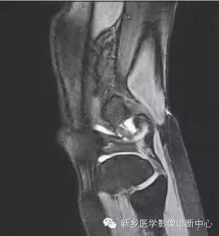 膝关节断层解剖+详细标注